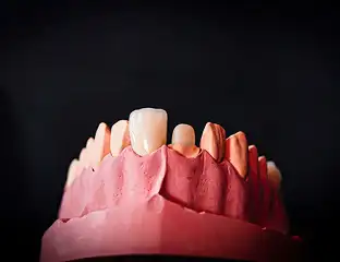 Вкладки и культевые штифтовые вкладки
